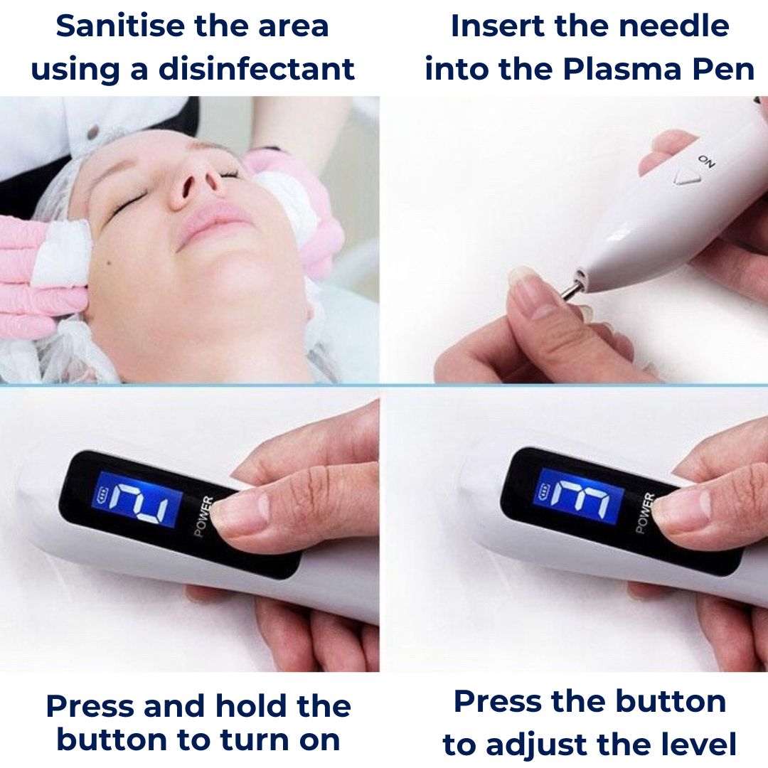 Mole Remover Pen – Non-Invasive Plasma Technology – Cordless & Rechargeable – At Home Skin Tag & Freckle Treatment