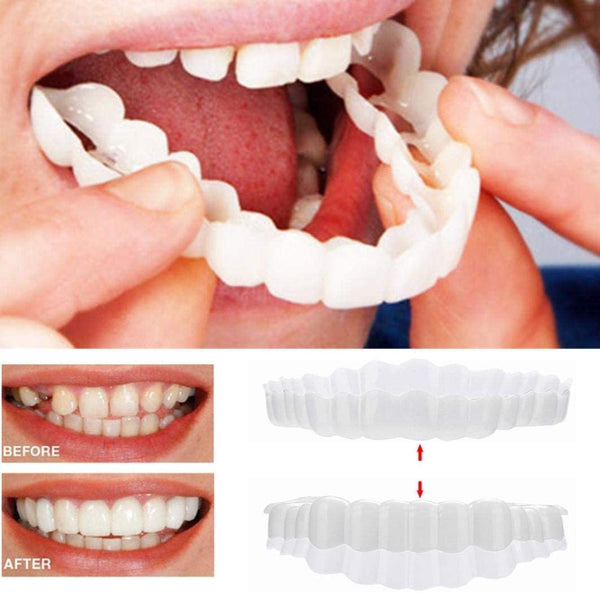 SmileMiracle | Custom Dental Veneers for Upper and Lower Jaw