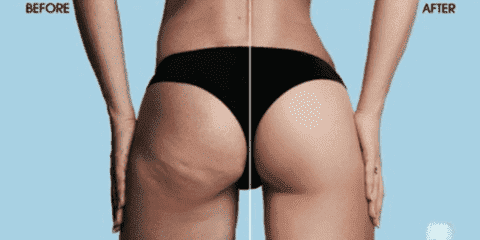 Silicone Massage Cups for Skin Tightening | HealthFlex