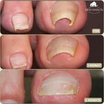 Effective nail correction – 10 NailPerfect with 10 free