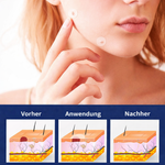 Skin Fold Remover | Painless & Natural Patch for Home Use