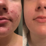 Skin Healing | Silicone Scar Patches