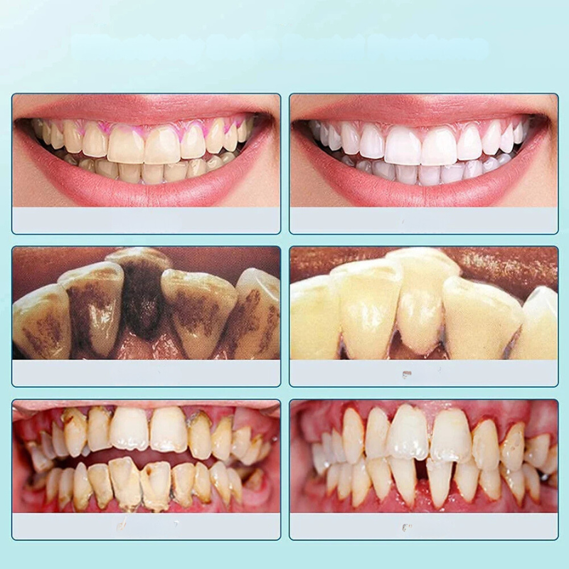 ZahnVital Sonic | Ultrasonic Toothbrush for Radiant Teeth