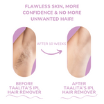 Gentle IPL Hair Removal – Painless At-Home Device