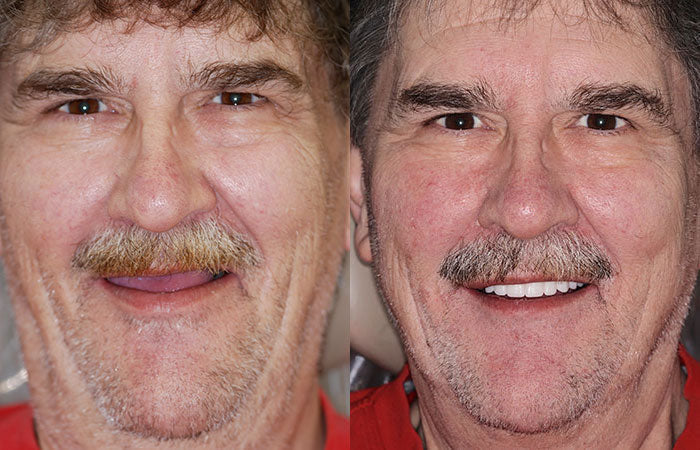 Full Denture Set Moldable Custom-Fit Upper and Lower