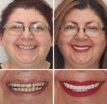 Full Denture Set Moldable Custom-Fit Upper and Lower