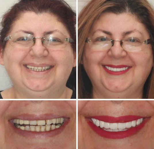 Full Denture Set Moldable Custom-Fit Upper and Lower