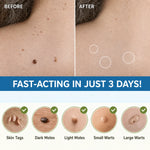 Skin Tag Removal Patches Gentle Non-Invasive Discreet Wear