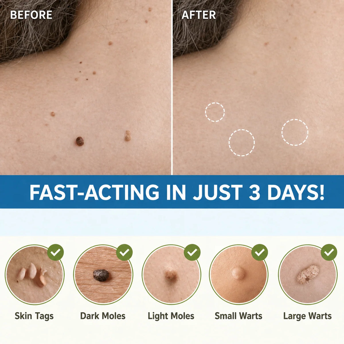 Skin Tag Removal Patches Gentle Non-Invasive Discreet Wear