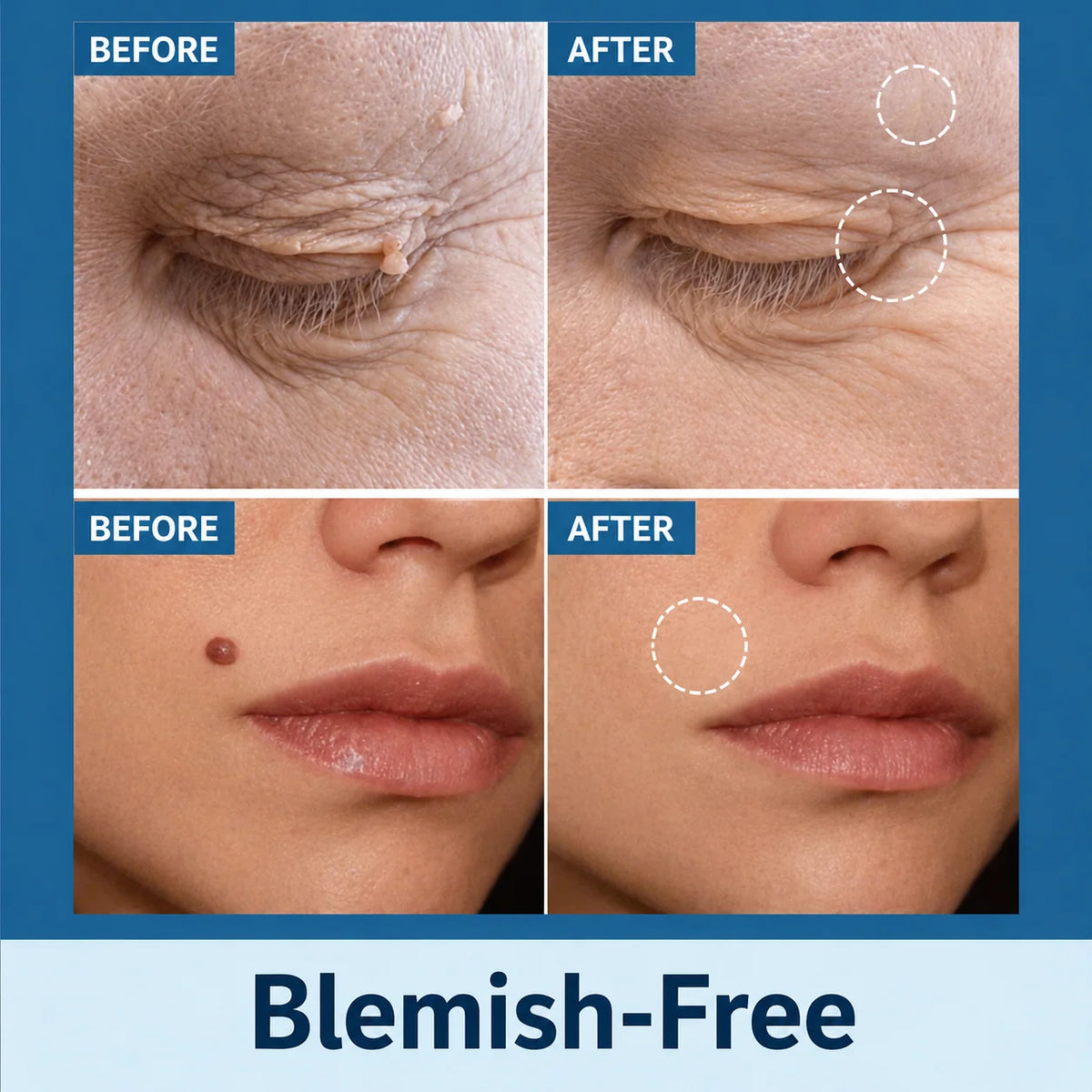 Skin Tag Removal Patches Gentle Non-Invasive Discreet Wear