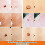 Spot Treatment Skin Tags & Dark Spots Gentle 20 Ml