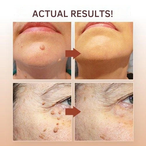 Wart & Skin Tag Remover Plant-Based Precision Applicator
