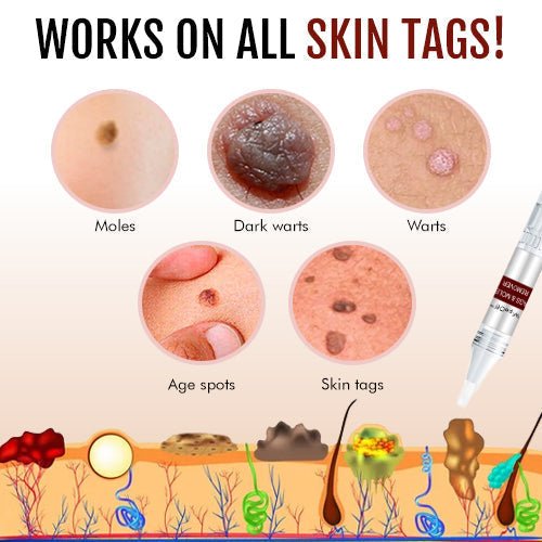Wart Remover | Precision Pen for Blemishes | Herbal Formula