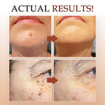 Wart Remover | Precision Pen for Blemishes | Herbal Formula