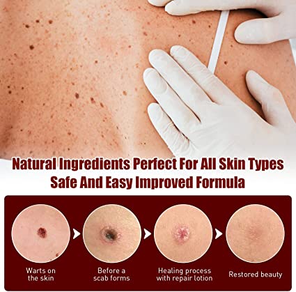 Wart Remover | Precision Pen for Blemishes | Herbal Formula