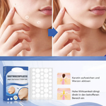 Skin-Friendly Remover Patches | Gentle Solution for Blemishes