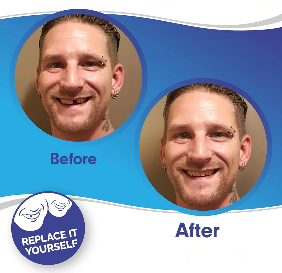 Full Veneer Set – Cosmetic Covers for Upper and Lower Jaw