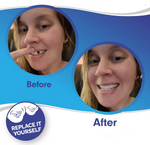 Full Veneer Set – Cosmetic Covers for Upper and Lower Jaw