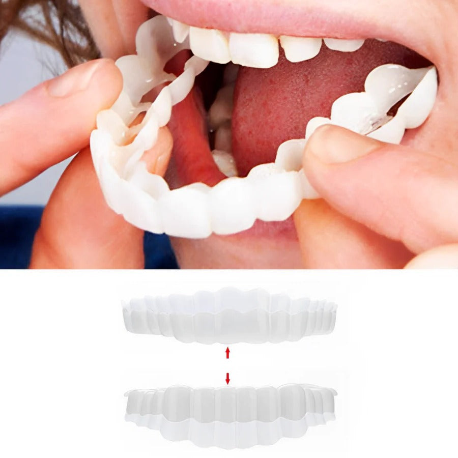 Full Veneer Set – Cosmetic Covers for Upper and Lower Jaw