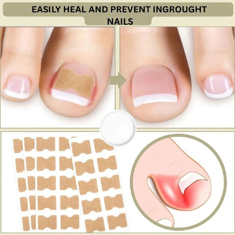 Adhesive toenail support strips for curved nails and daily care
