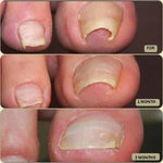 Adhesive toenail support strips for curved nails and daily care