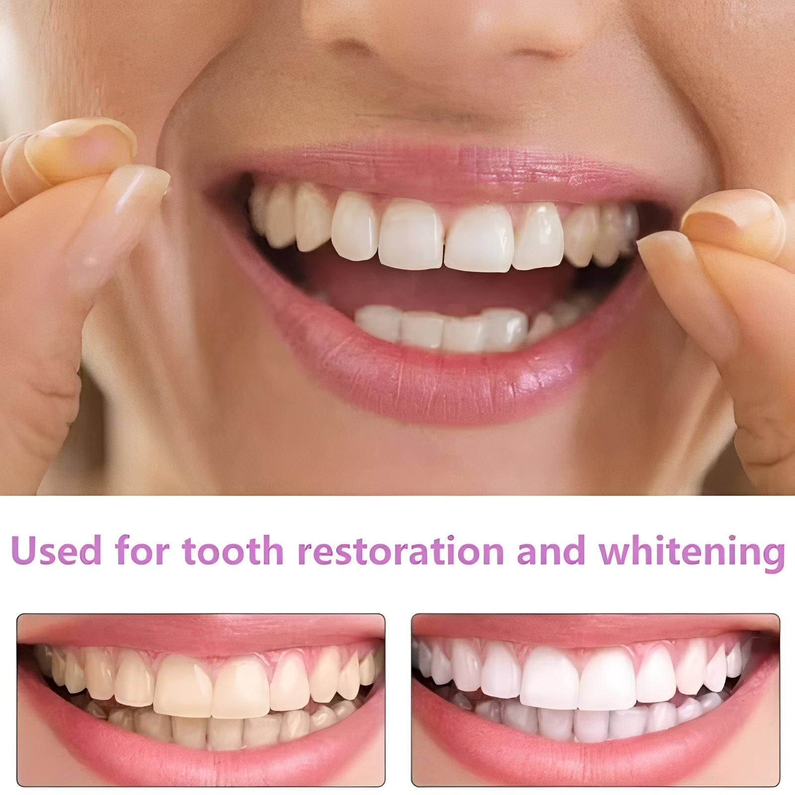 Aesthetic Tooth Covers for Adults, 2-Piece Set
